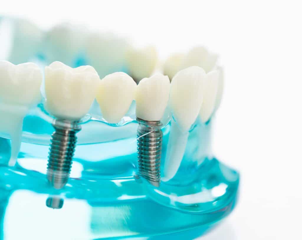 Dental implants model with transparent gums