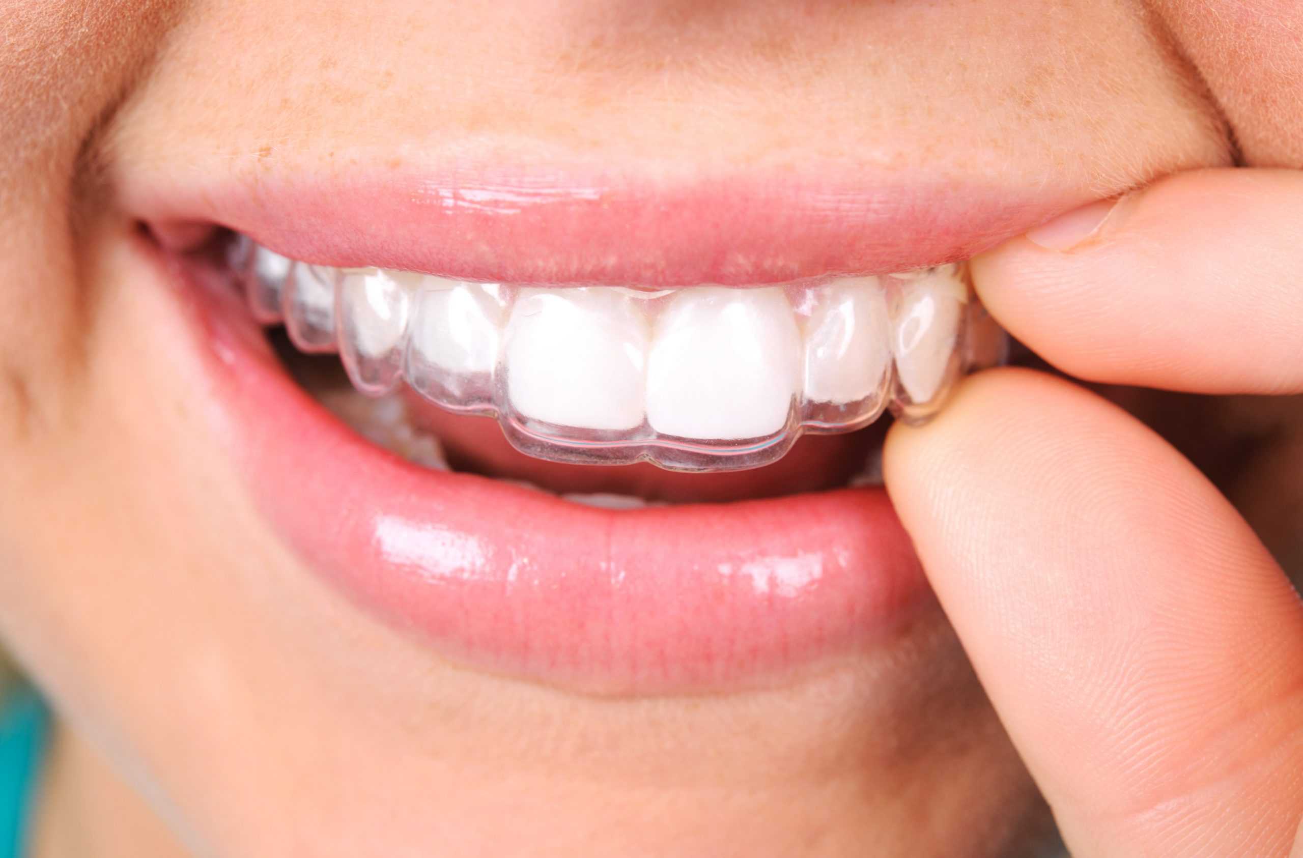 Close up of a woman places her Invisalign aligners over her teeth.