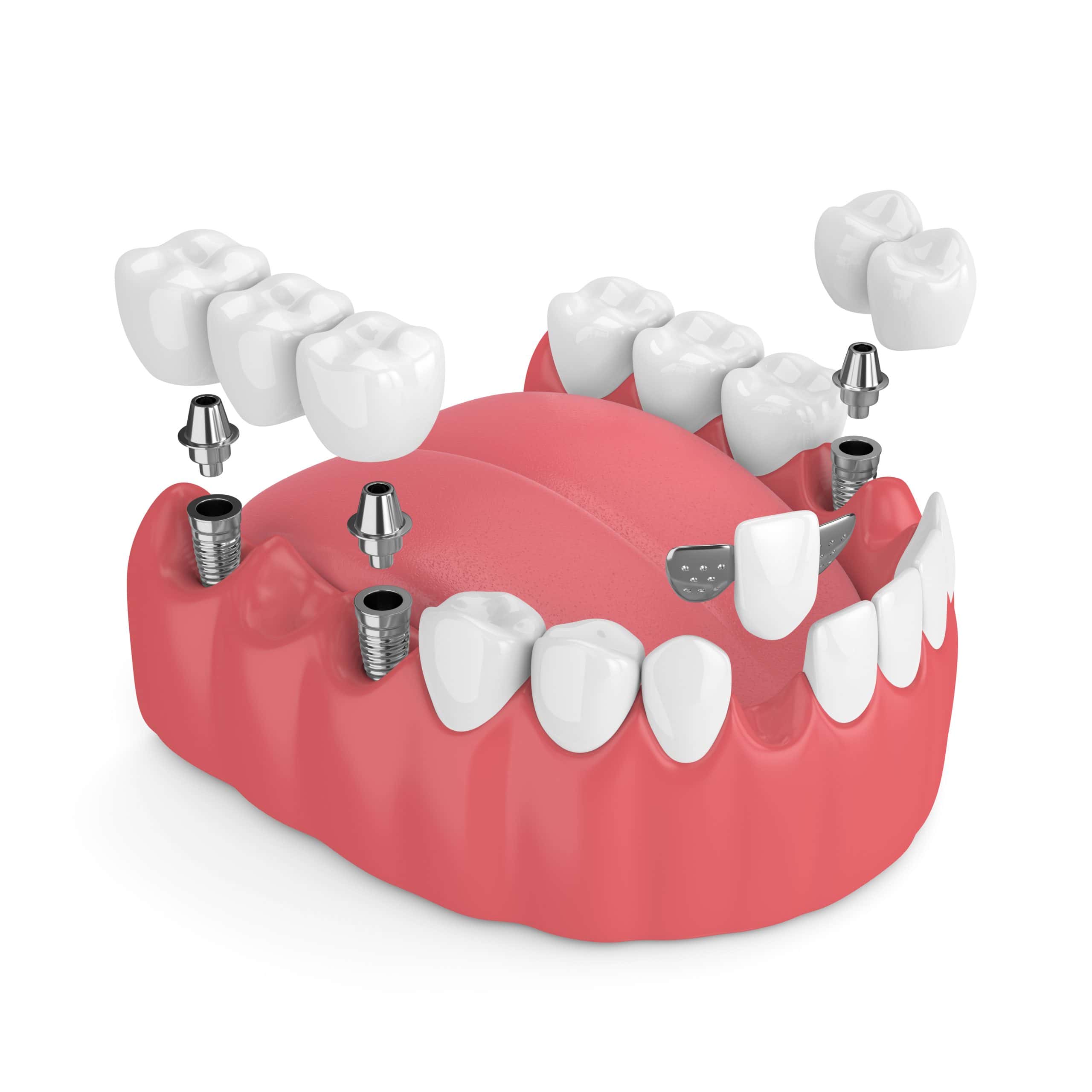 3d model of dental implants and dental bridges scaled