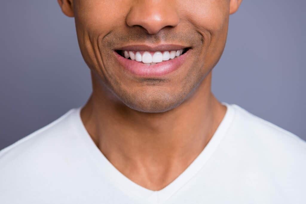 Man smiling to show gum bleaching.
