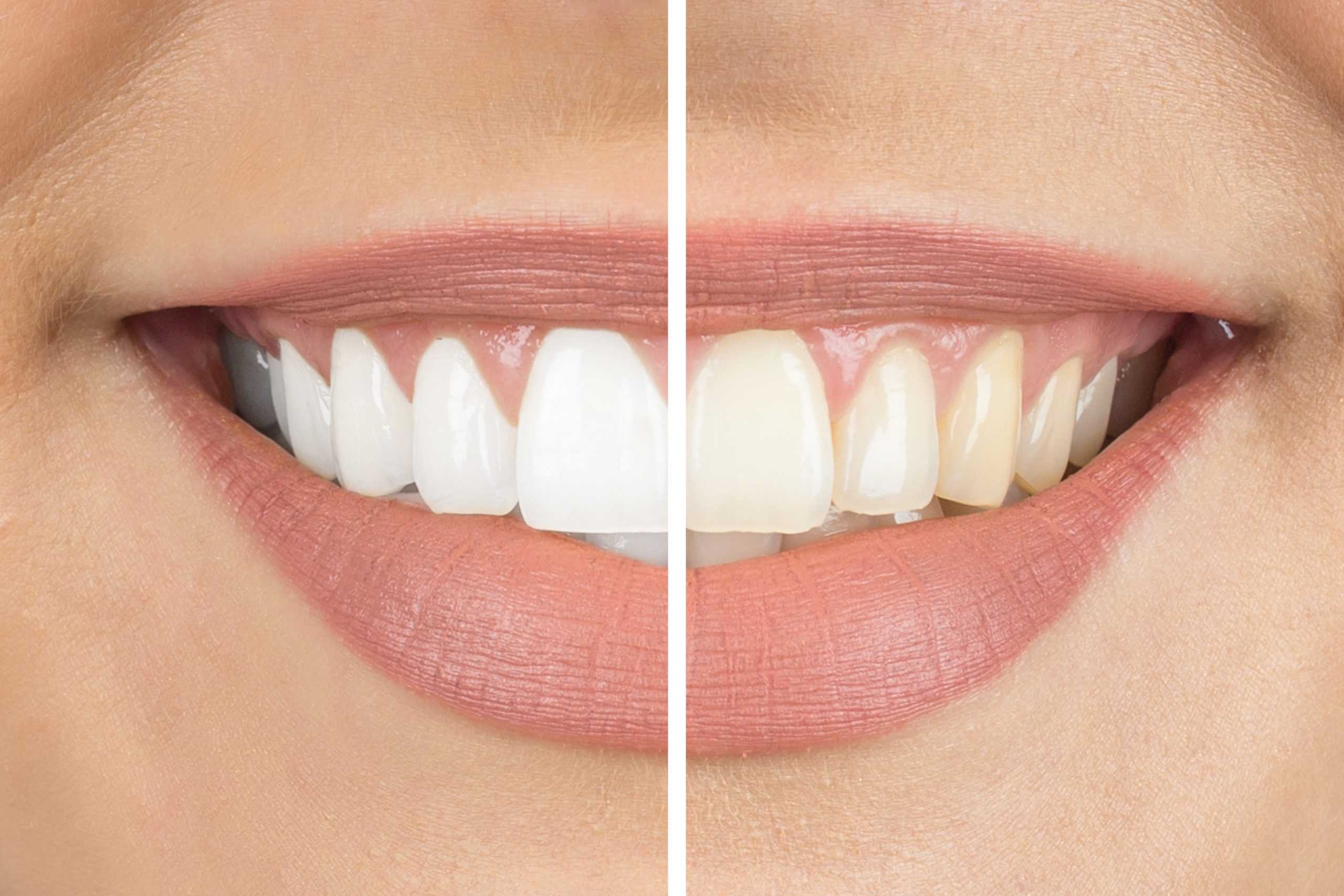 teeth whitening side-by-side