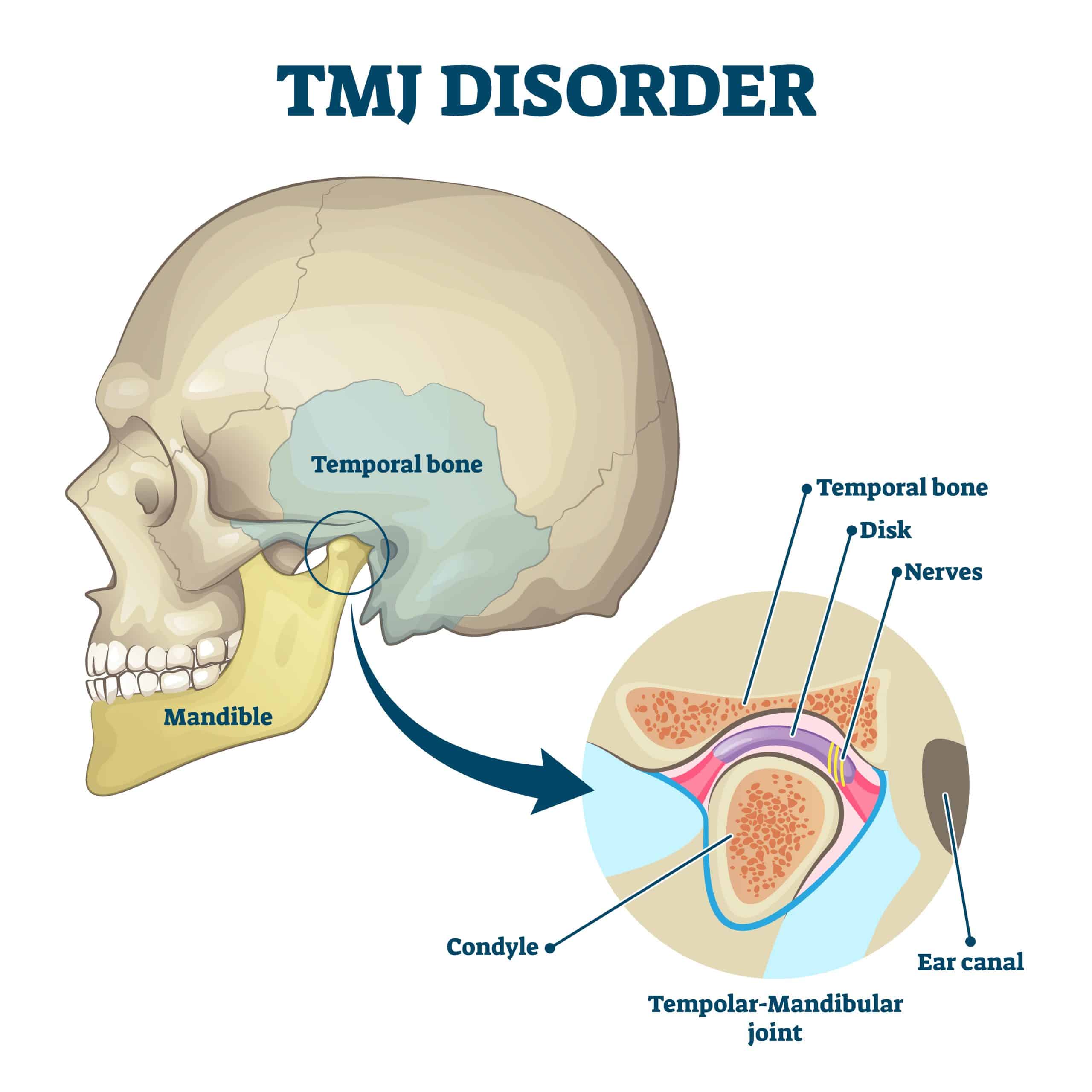 TMJ Disorder diagram