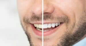 Close up of whitened teeth vs stained teeth side by side