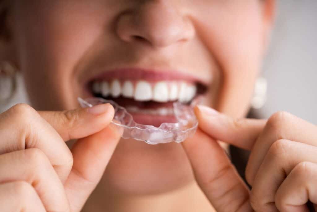 Woman with bruxism putting in a thin mouth guard