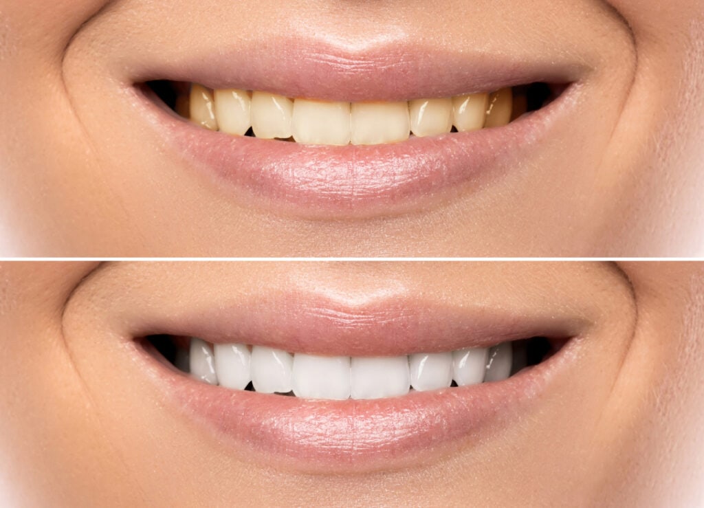 teeth before and after smile makeover