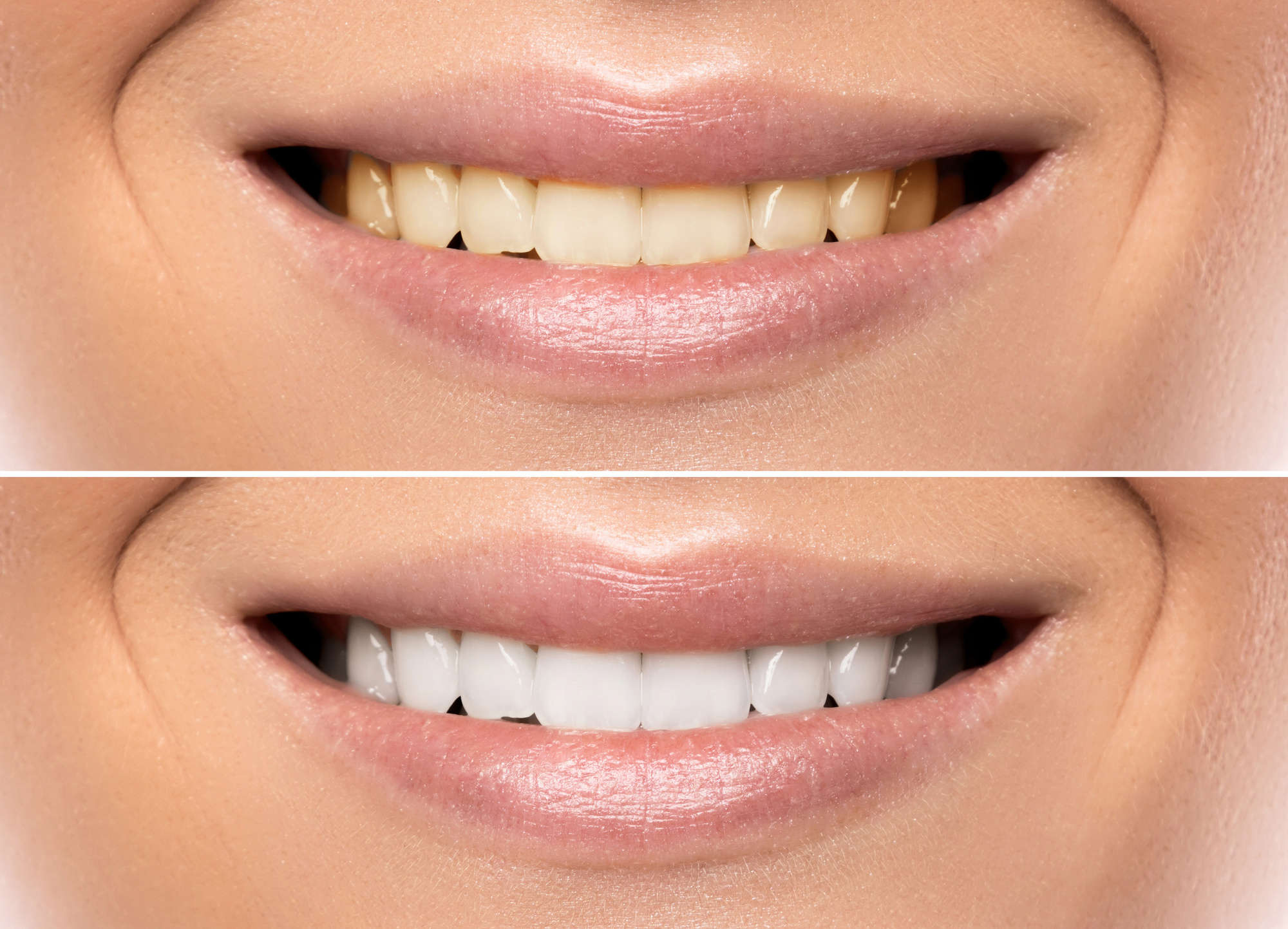 teeth before and after smile makeover