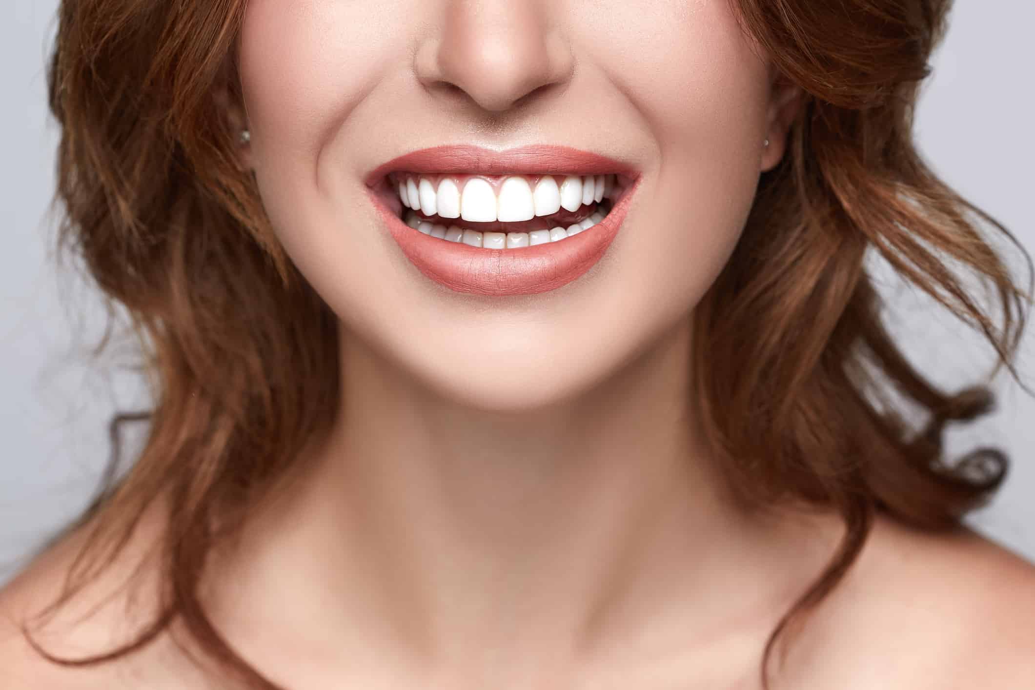 Close up of a woman with dental veneers