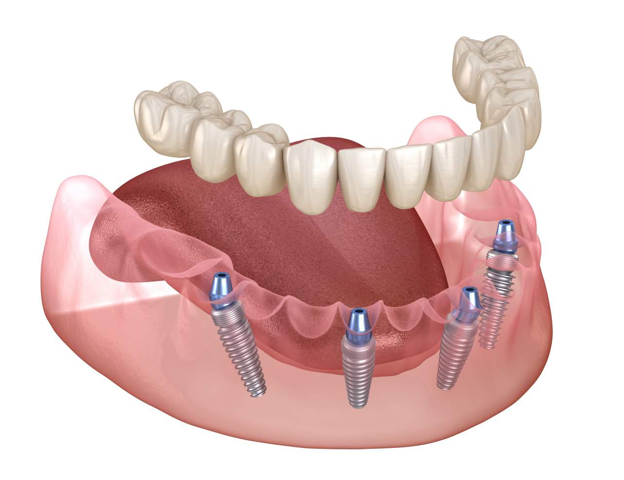All on 4 dental implants 3d illustration