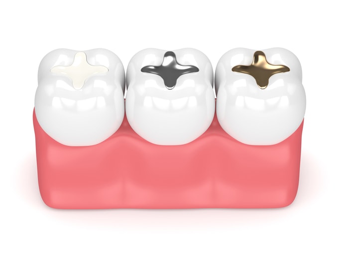different dental filling materials