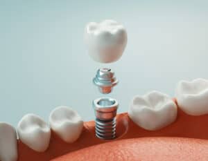 Dental implant 3D rendering