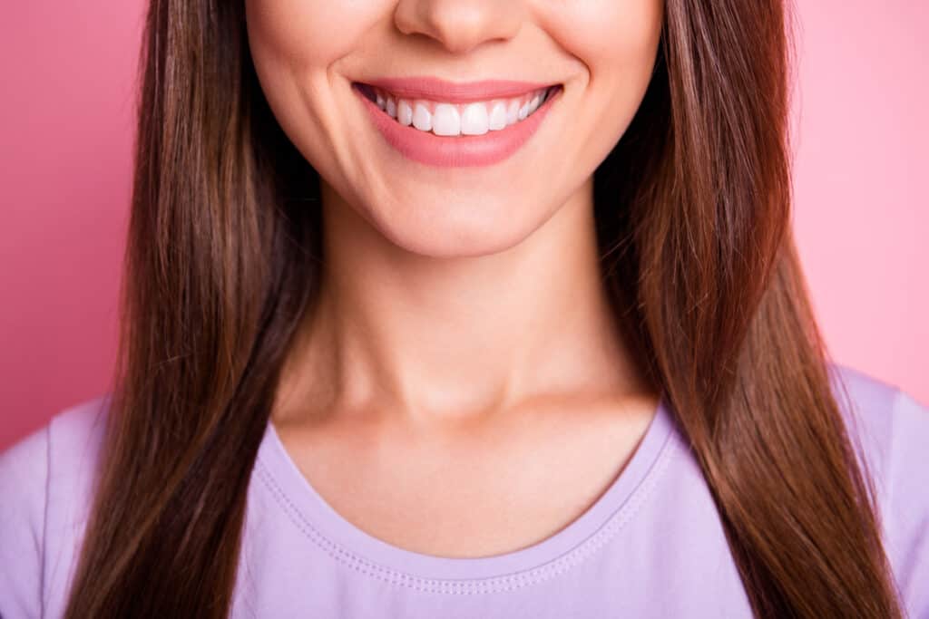 Veneers - close up of women smiling