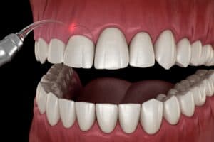 Gum contouring procedure 3D illustration