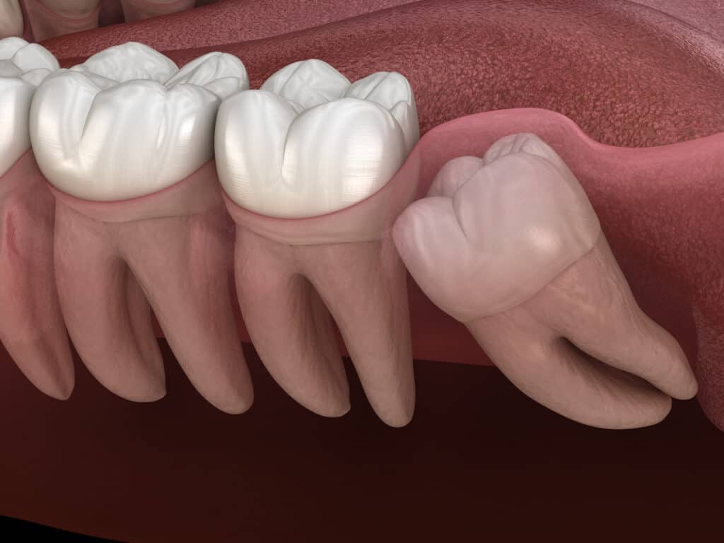 Impacted wisdom tooth 3D rendering