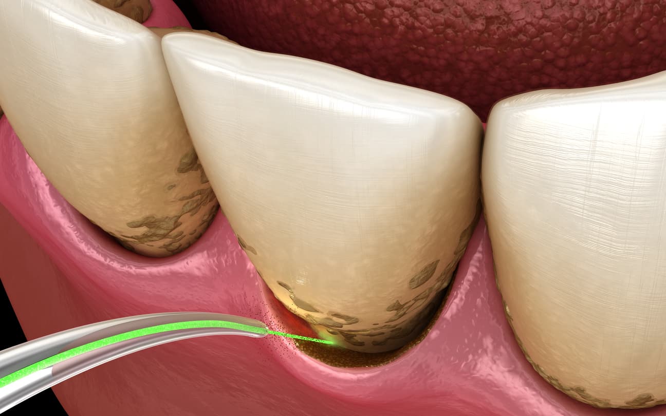 LANAP Laser Gum Surgery 3D illustration