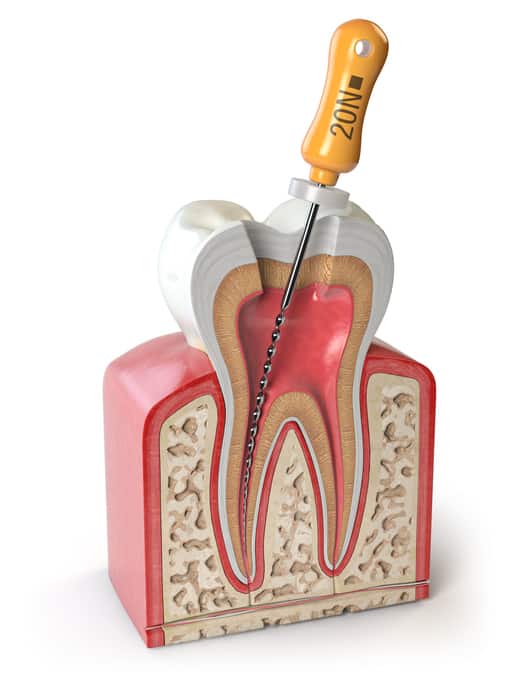 root canal 3d illustration