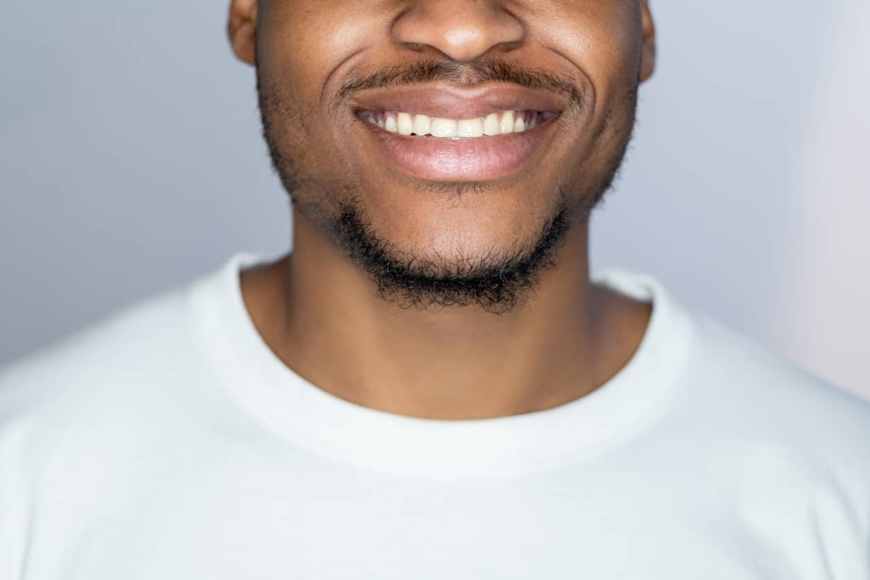 Man of color smiling - Gum whitening procedure